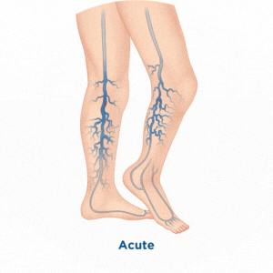 difference of acute and chronic dvt