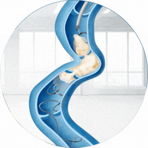 foamed sclerosant and embolization coils being used to treat pelvic congestion syndrome