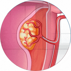 particles injected into uterine arteries to treat uterine fibroid