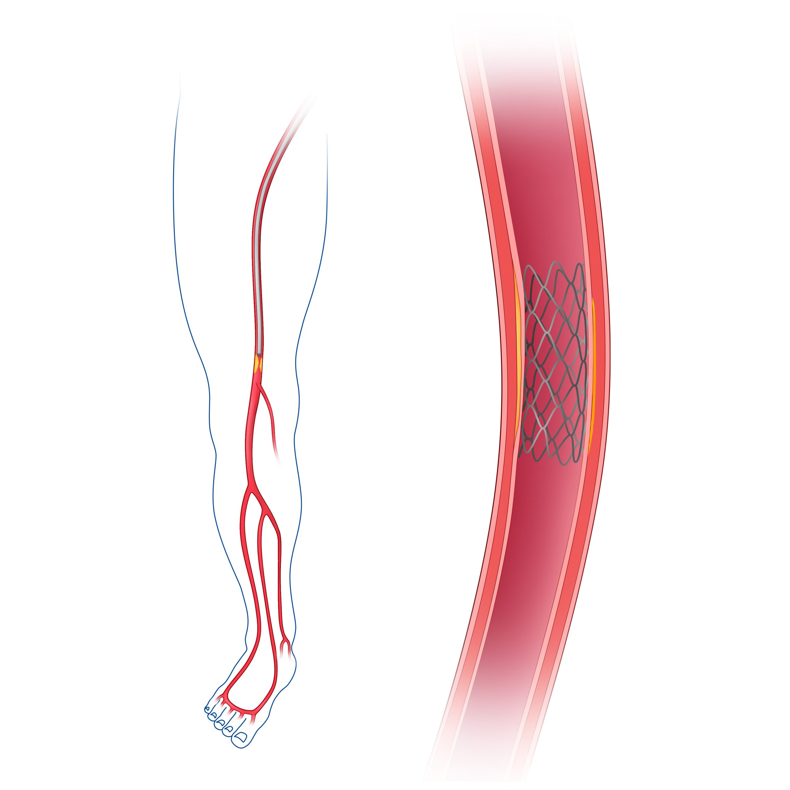 stent