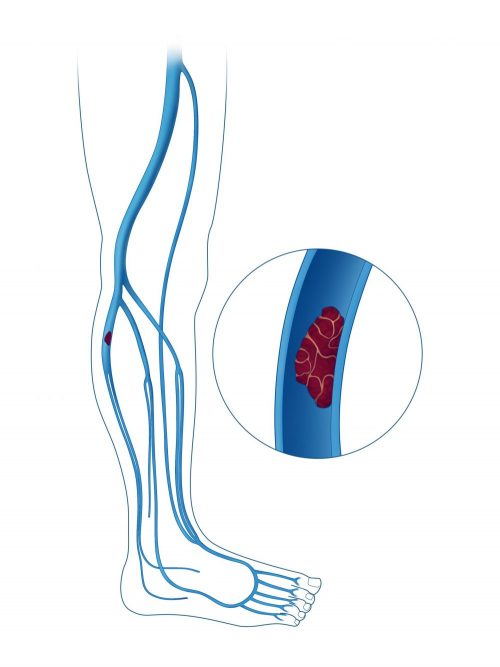 deep vein thrombosis