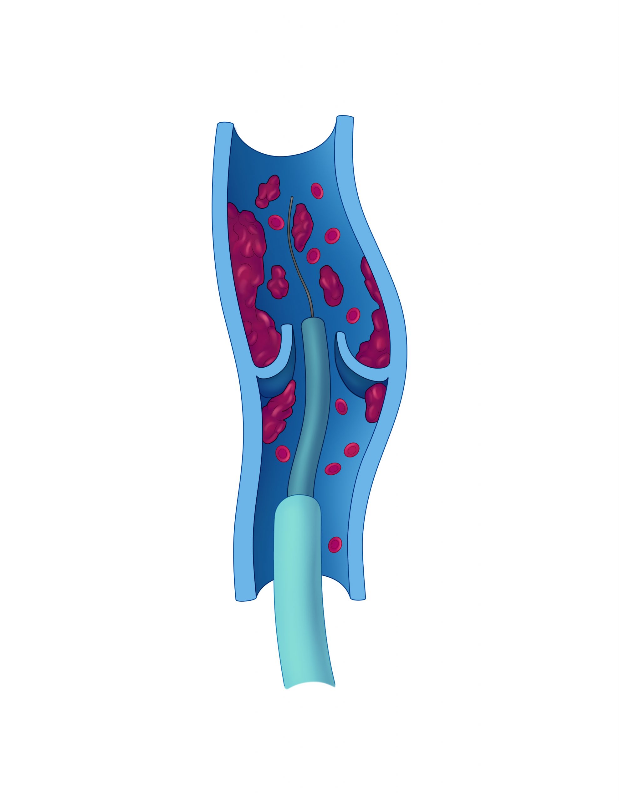 thrombectomy