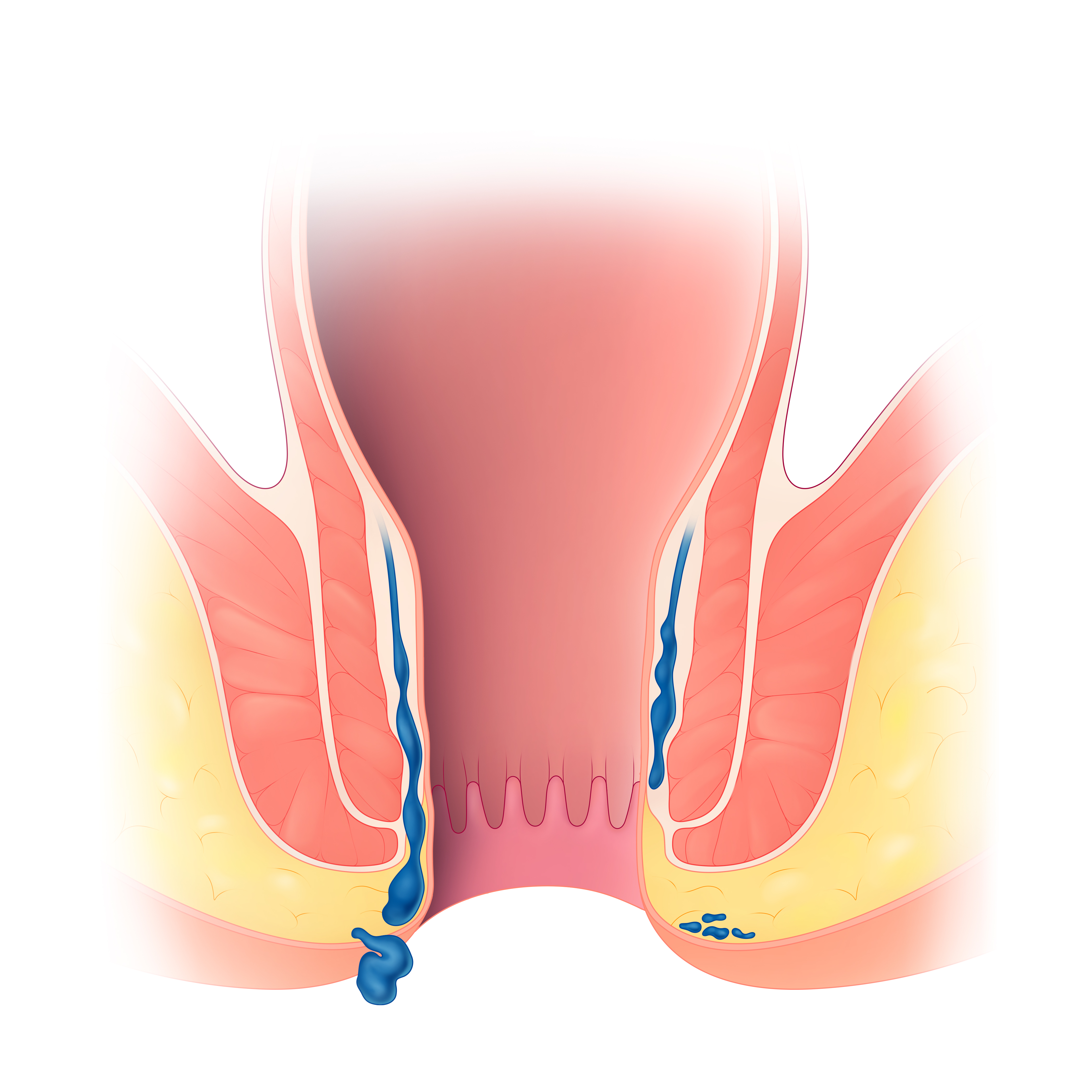 hemorrhoids
