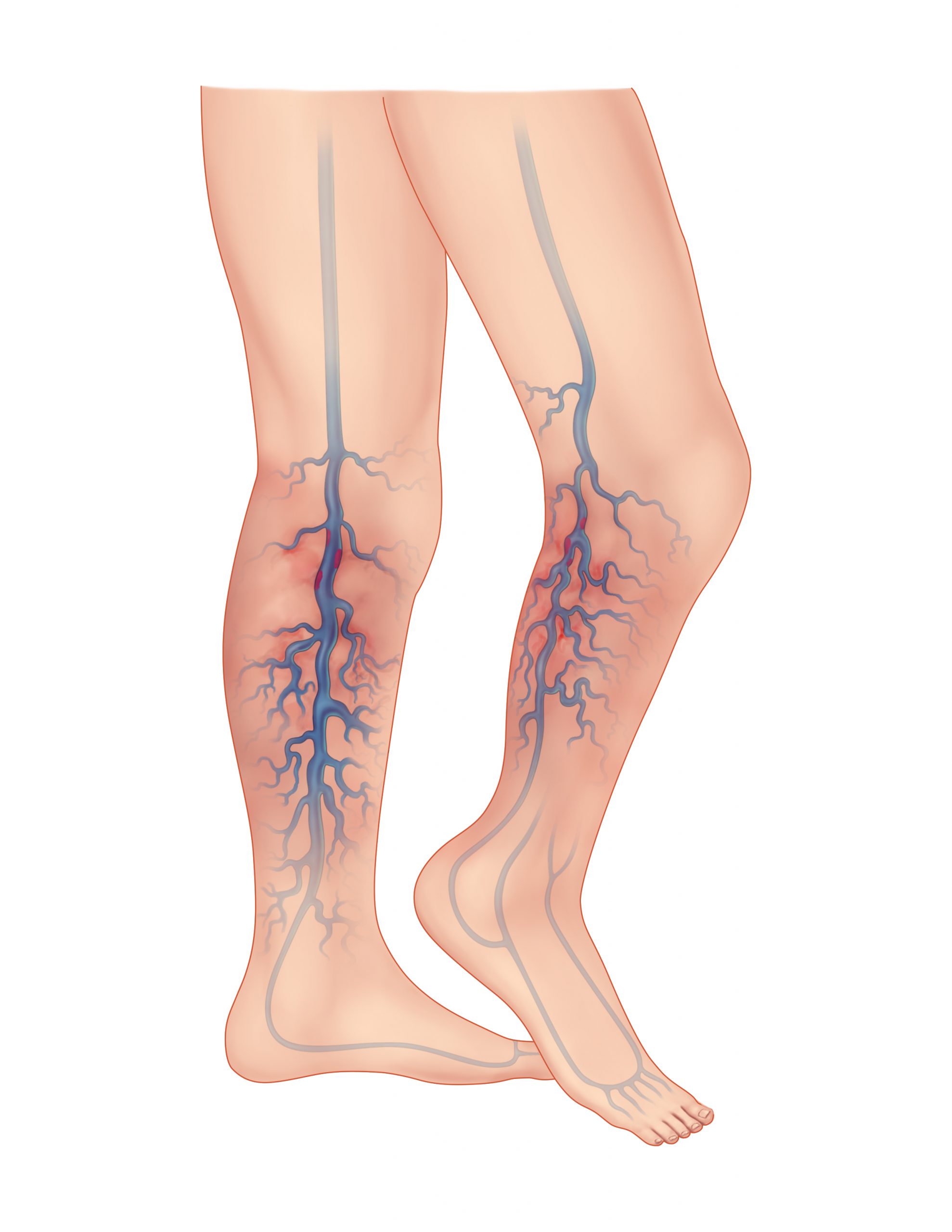 chronic deep vein thrombosis