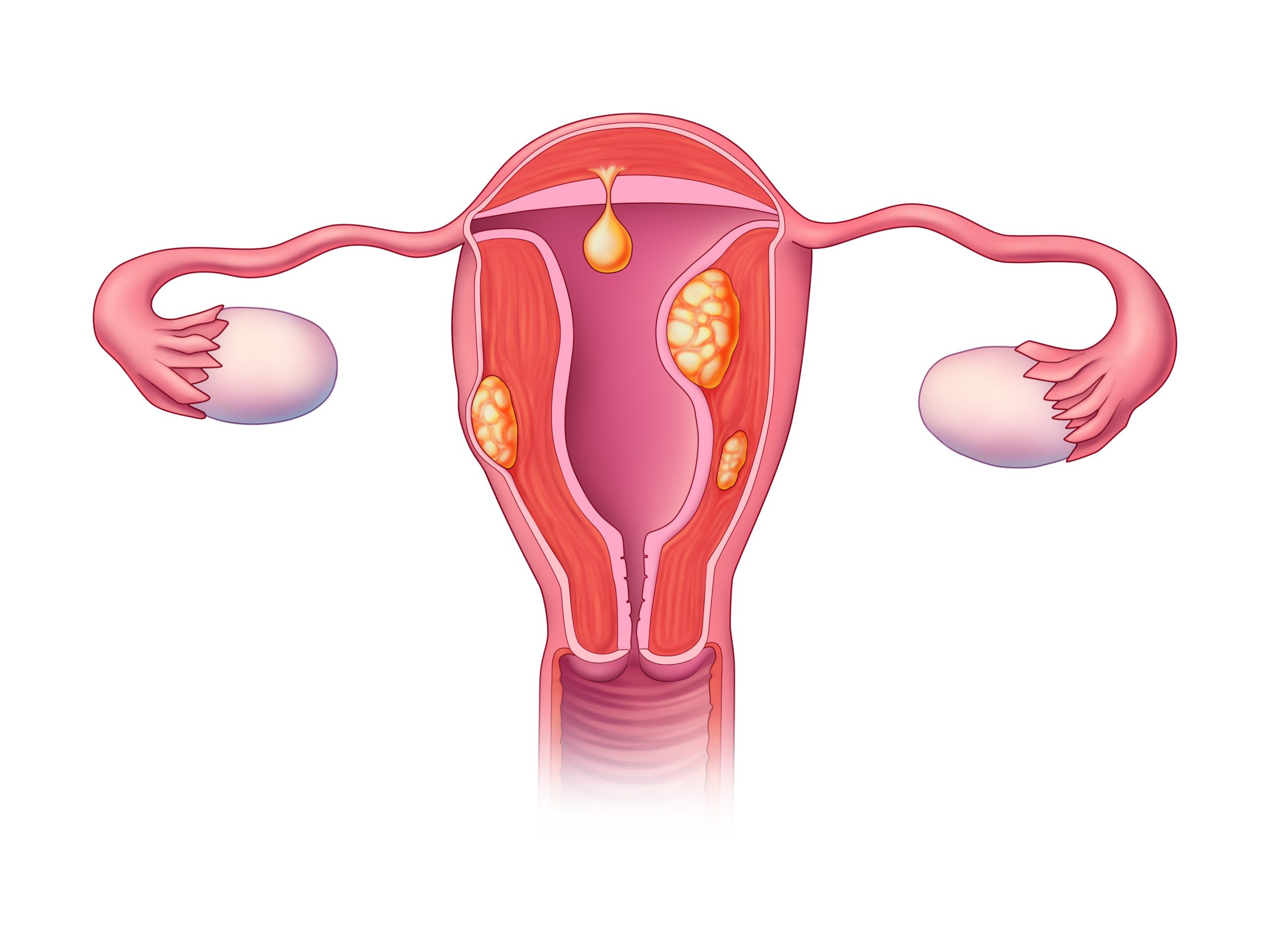 uterine fibroids (leiomyoma)