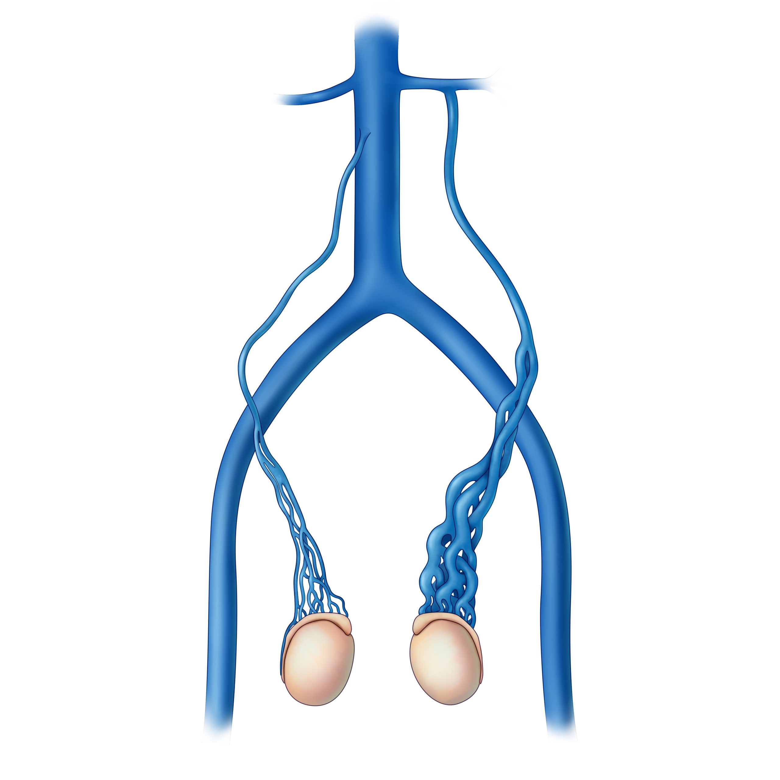varicocele illustration