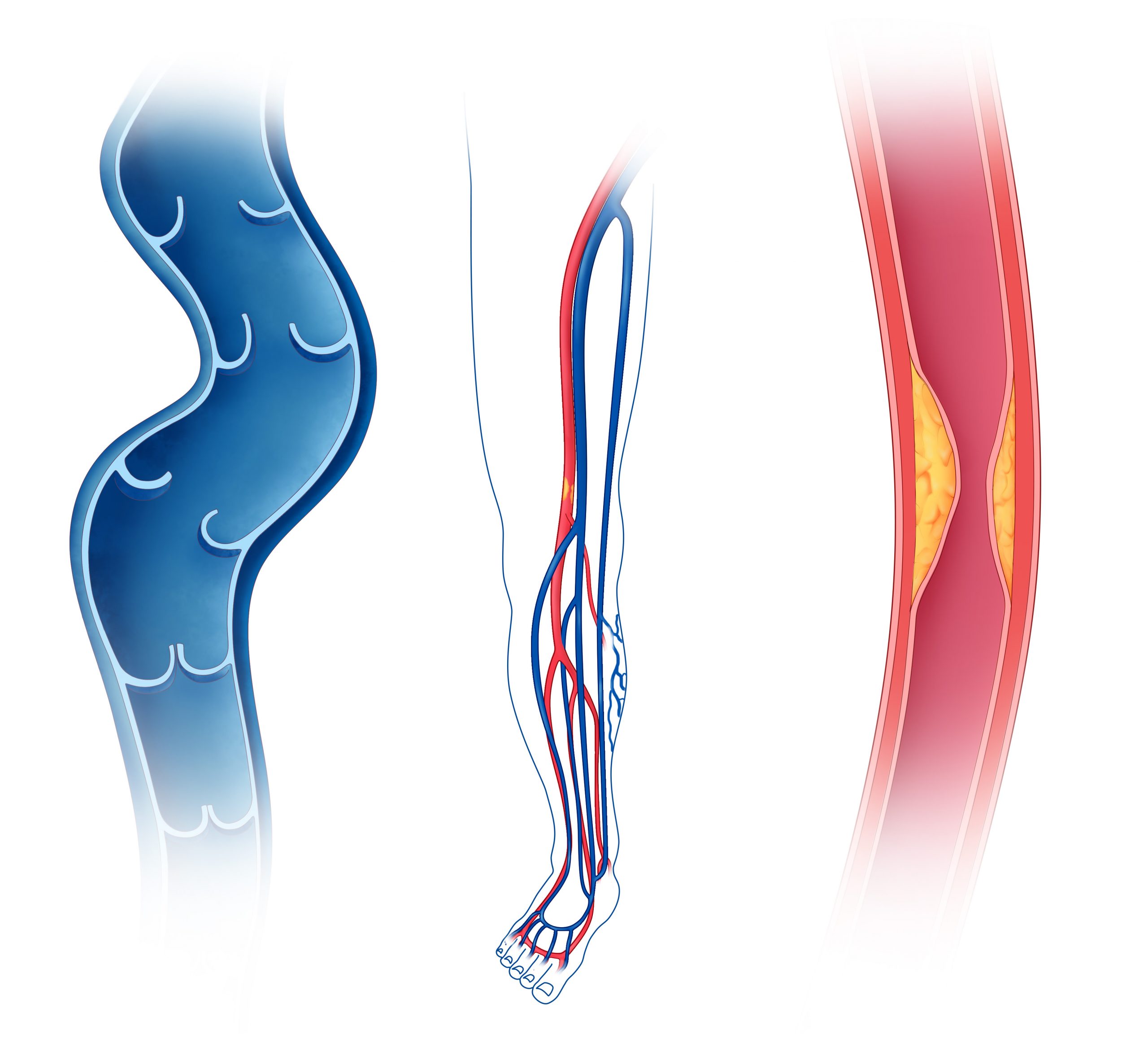 vascular disease