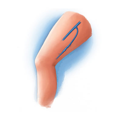 Chronic Venous Insufficiency at Intermountain Vein Center