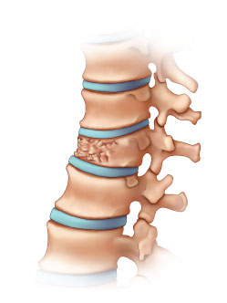 compression fracture