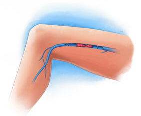 Deep vein thrombosis at Intermountain Vein Center