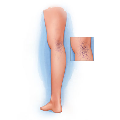 Spider Veins at Intermountain Vein Center in Utah