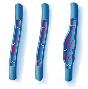 Vein Diseases at Intermountain Vein Center