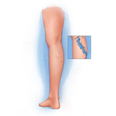 Utah Varicose Veins Treatment at Intermountain Vein Center